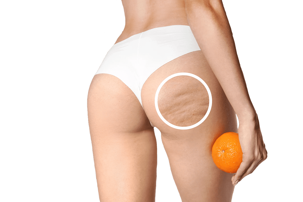 Diminuer la cellulite
